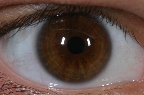 Kaneez's Right Eye