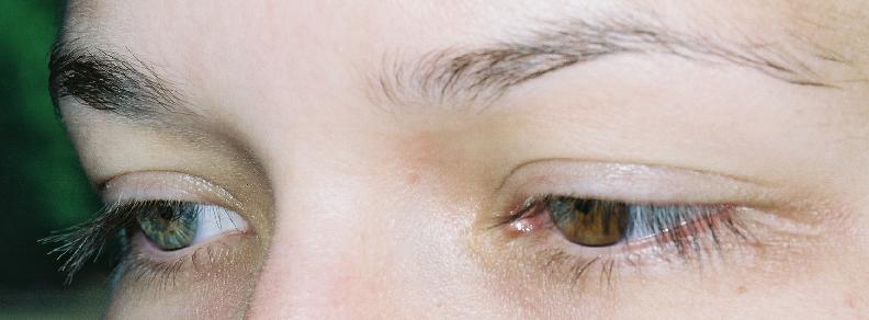 Both eyes, and eyebrows