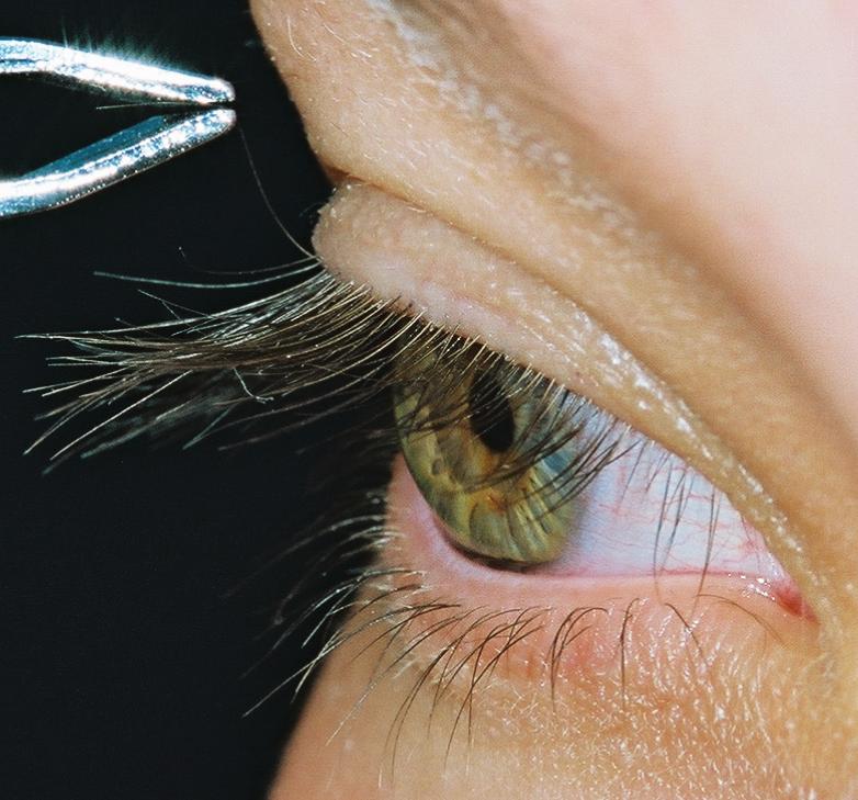 tweezers 1