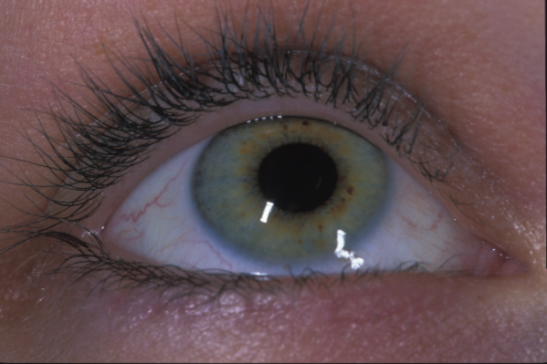 Katie's eye